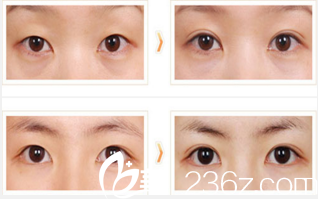 韩国首尔整形医院薄眼皮,大眼睛手术 韩国首尔整形医院薄眼皮,大眼睛手术