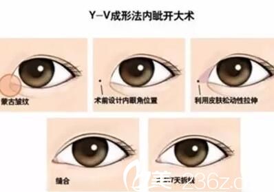 长春麦西美嘉Y-V成形法开内眼角手术 长春麦西美嘉Y-V成形法开内眼角手术