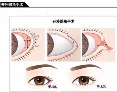 长春麦西美嘉开外内眼角手术 长春麦西美嘉开外内眼角手术