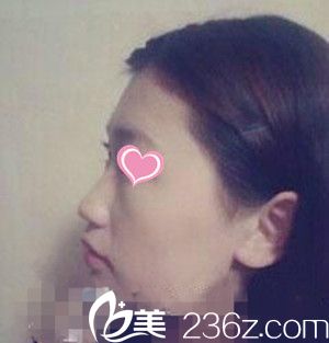 韩国LUX整形医院隆鼻 韩国LUX整形医院隆鼻