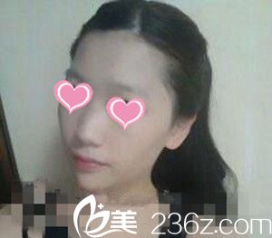 韩国LUX整形医院自体脂肪丰额头 韩国LUX整形医院自体脂肪丰额头