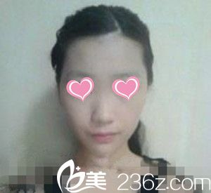 手术前照片 手术前照片