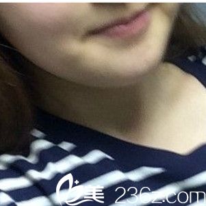 激光溶脂手术后十天 激光溶脂手术后十天