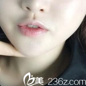 韩国LUX整形医院做激光溶脂瘦下巴手术很厉害，看看我做后的效果