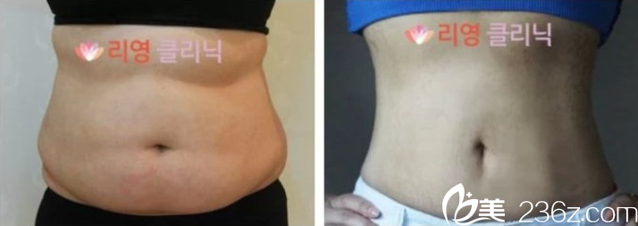 金光晏院长腰腹部吸脂案例 金光晏院长腰腹部吸脂案例