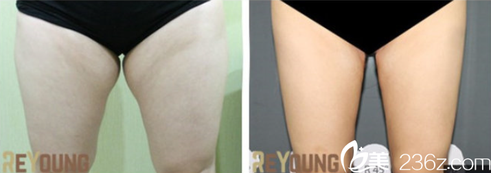 大腿吸脂案例 大腿吸脂案例