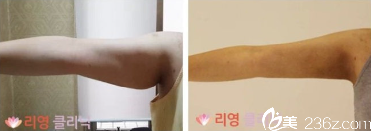 胳膊吸脂案例 胳膊吸脂案例