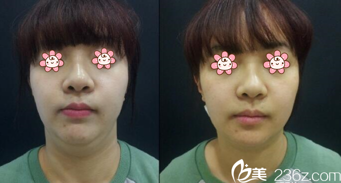 李俊宇院长面部吸脂案例 李俊宇院长面部吸脂案例