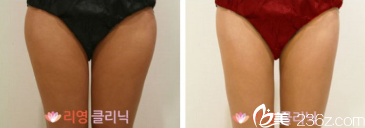 严日准院长大腿吸脂案例