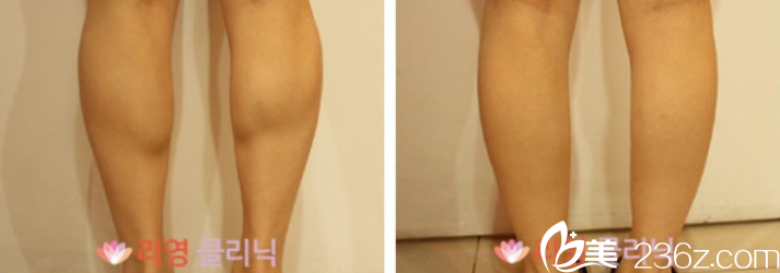 小腿塑形案例