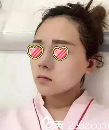 在杭州连天美做鼻综合当天照片