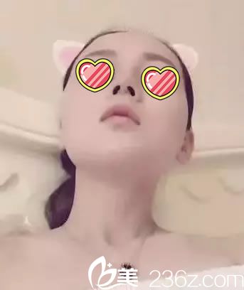 鼻综合手术后昂头看切口情况