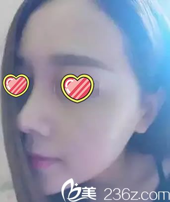 鼻综合手术两周鼻部特写照片