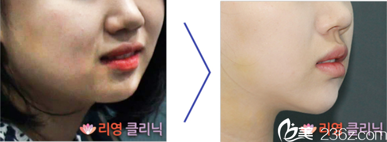 崔峻榮院长面部吸脂案例1