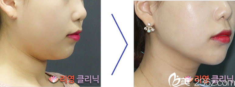 崔院长面部吸脂案例2