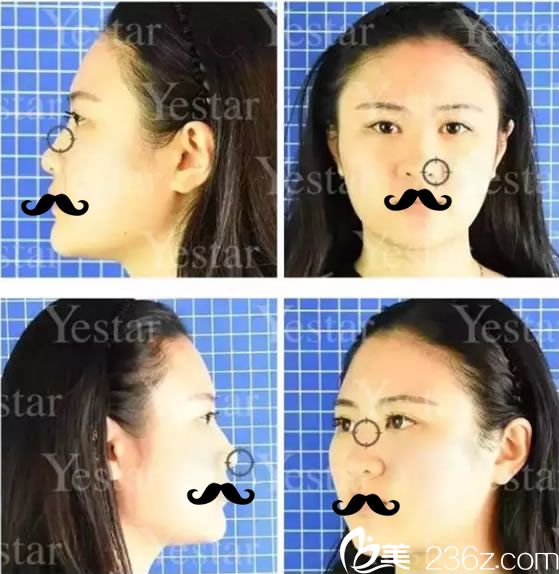 做鼻综合手术前的全方面塌鼻子照片 做鼻综合手术前的全方面塌鼻子照片