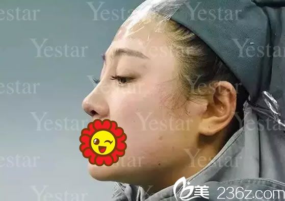 做完鼻综合整形手术即刻<span style= 做完鼻综合整形手术即刻<span style=