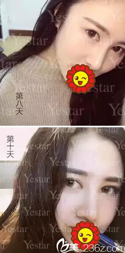 鼻综合整形手术第8天和第10天恢复照 鼻综合整形手术第8天和第10天恢复照