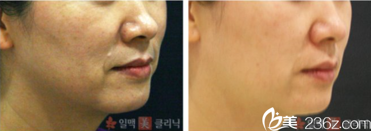 金美静院长面部除皱案例 金美静院长面部除皱案例