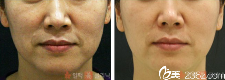 面部皱纹改善案例 面部皱纹改善案例