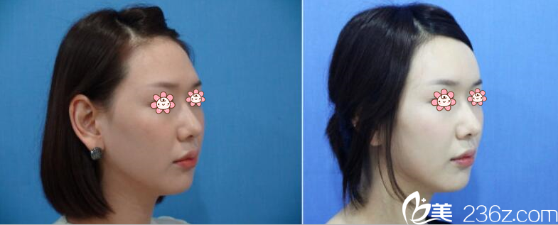 金基熏院长脂肪填充额头案例 金基熏院长脂肪填充额头案例