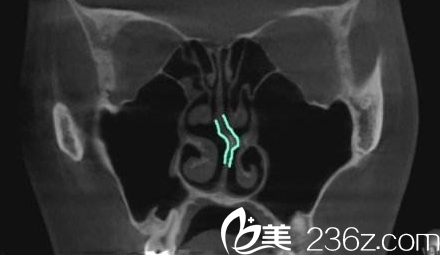 N Plus医院鼻部CT检测图 N Plus医院鼻部CT检测图
