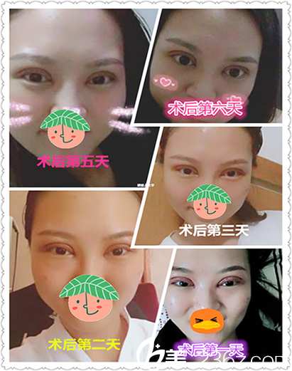 合肥华美整形美容医院赵辑全切双眼皮术后第1-6天恢复过程图