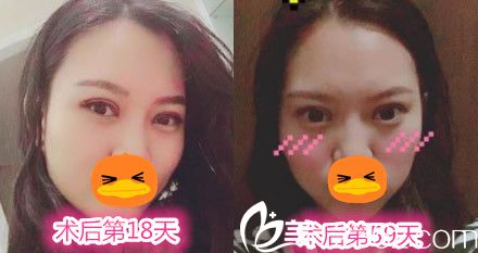 赵辑做双眼皮手术后第18天和59天的效果图