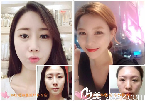 爱琳整形医院面部轮廓案例 爱琳整形医院面部轮廓案例