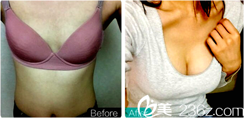 金院长隆胸案例