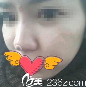 注射隆鼻手术当天