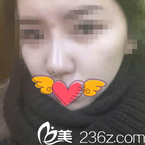 鼻整形术后半个小时