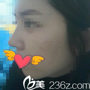 注射隆鼻后出院在地铁上