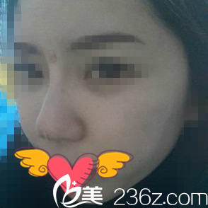 晚上鼻子消肿后的样子