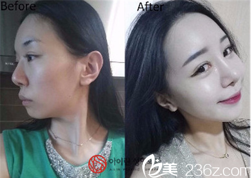 金院长鼻部整形案例 金院长鼻部整形案例