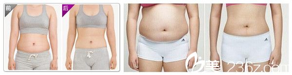 杨建华主任埋线减肥案例 杨建华主任埋线减肥案例