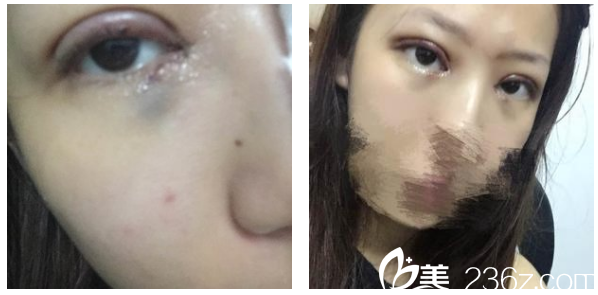 深圳军科刘月更双眼皮第5天