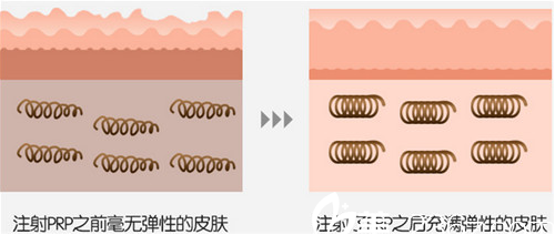 PRP自体脂肪移植 PRP自体脂肪移植
