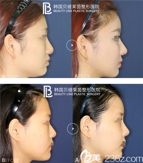 PRP自体脂肪移植真人案例 PRP自体脂肪移植真人案例