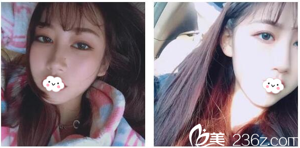 刘月更做的DD数码双眼皮1个月效果图