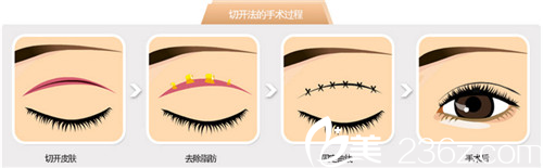 beautyline双眼皮手术过程 beautyline双眼皮手术过程