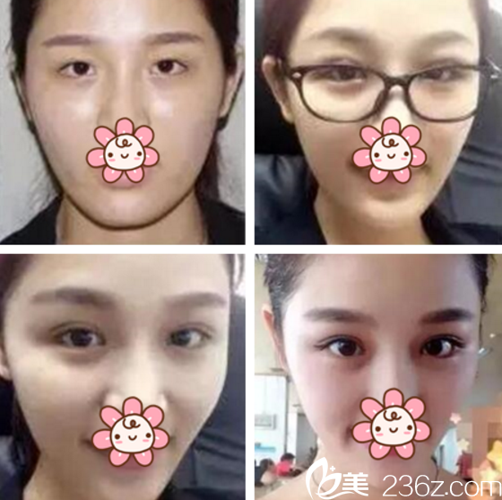 崔恒硕院长眼修复案例