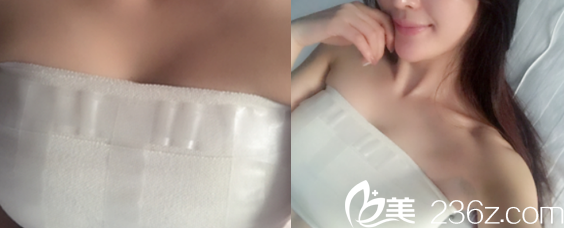 在合肥华美整形美容医院做假体丰胸手术后第4天的样子