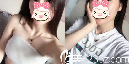 合肥华美整形美容医院赵辑做假体隆胸术后第7天拆线前后照