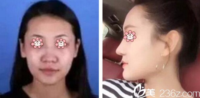 张裕珍院长隆鼻案例