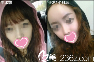 面部自体脂肪填充效果前后对比