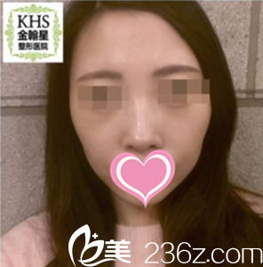 术前照片 术前照片