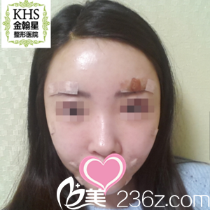 面部填充当天效果 面部填充当天效果