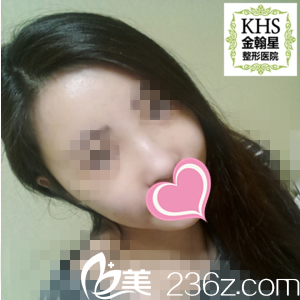 面部脂肪填充术后2周情况 面部脂肪填充术后2周情况