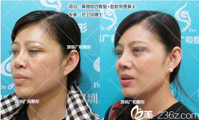 深圳广和尹卫民鼻综合失败修复+肋软骨塑鼻尖案例